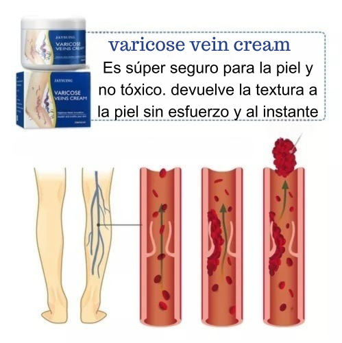 VARICOSE VEINS🐍TRATAMIENTO PARA VARICES 👩🏽🦱🧔🏻