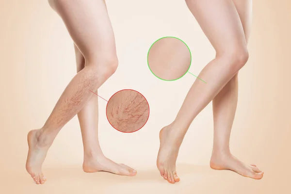 VARICOSE VEINS🐍TRATAMIENTO PARA VARICES 👩🏽‍🦱🧔🏻